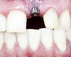 Clínica Dental Puchol implante de diente